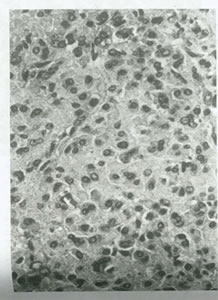بيماريهاي تخمدان و لوله هاي رحمي چیست؟(1)